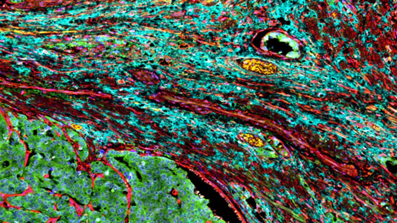 Tumors Can Coax Neighboring Cells Into Supporting Their Growth