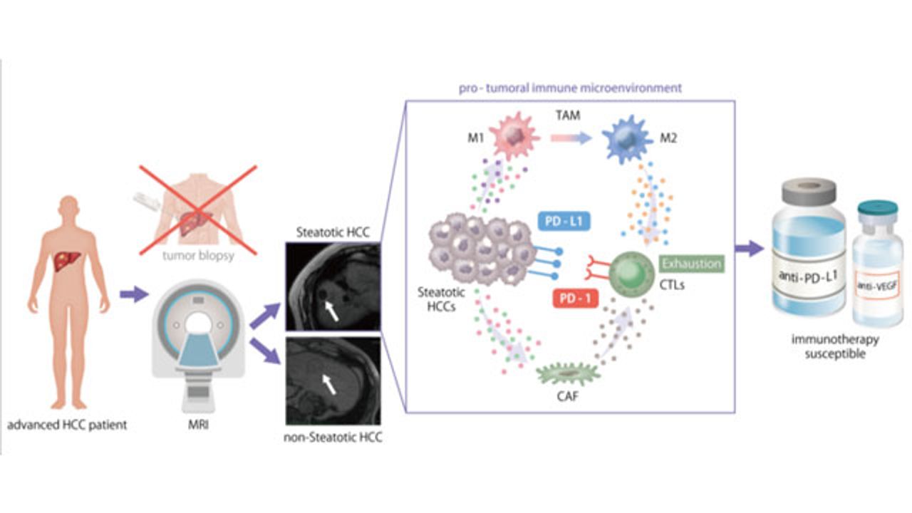 Fat Accumulation in Liver Tumors Influences Response to Immunotherapy