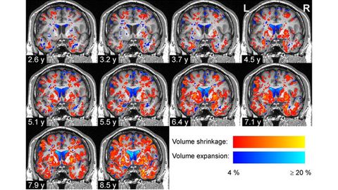 Mapping Shows How the Brain Shrinks in Parkinson's Disease Mapping Shows How the Brain Shrinks in Parkinson's Disease