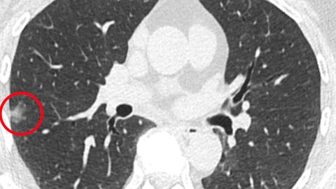 Imaging Approach Helps To Detect Lung Cancer Earlier