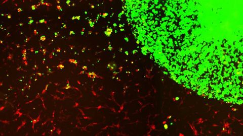 Stem Cell Therapy Engineered To Treat Aggressive Brain Cancer Stem Cell Therapy Engineered To Treat Aggressive Brain Cancer