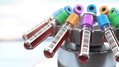 Multiple Myeloma Test Detects More Deadly Forms of the Disease Multiple Myeloma Test Detects More Deadly Forms of the Disease