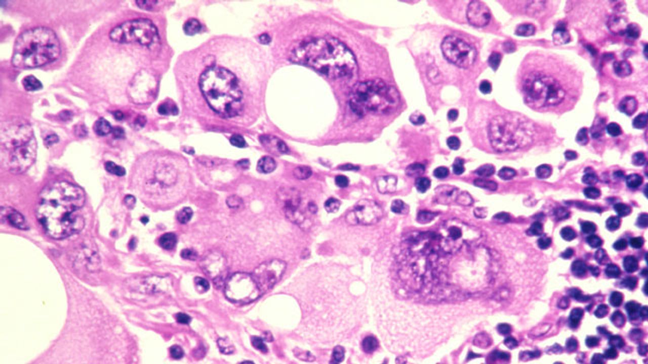 Peptide Combats Cancer Progression in Animal Model