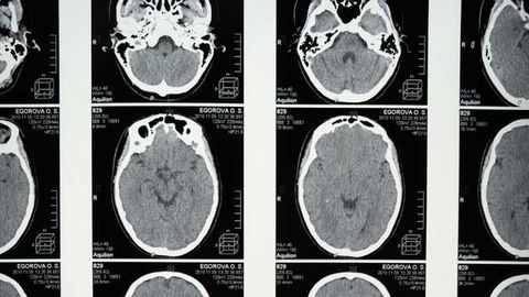 Short-Term Mindfulness Training Does Not Cause Structural Brain Changes Short-Term Mindfulness Training Does Not Cause Structural Brain Changes