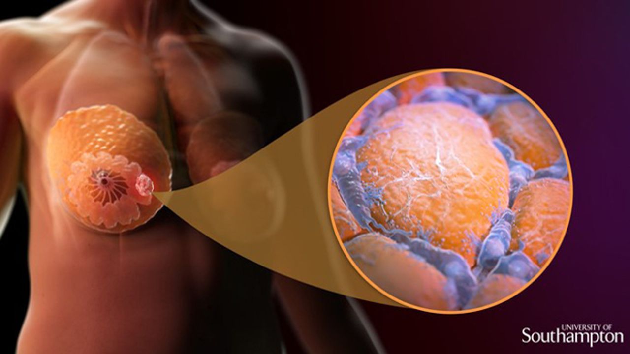 New Biomarker Discovery Could Help Personalize Breast Cancer Treatment