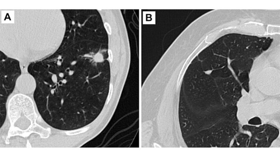 AI-Based Tool Helps Physicians To Predict Cancer Risk of Lung Nodules content piece image