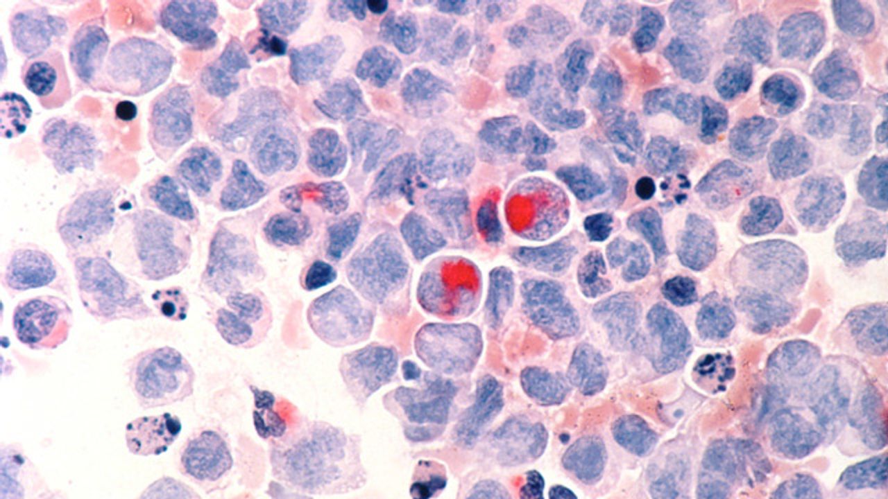CAR T-Cell Therapy Targets Cells That Cause Leukemia Relapse