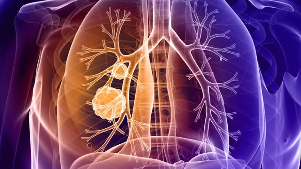 Immunotherapy Combination Could Extend Lives of Lung Cancer Patients
