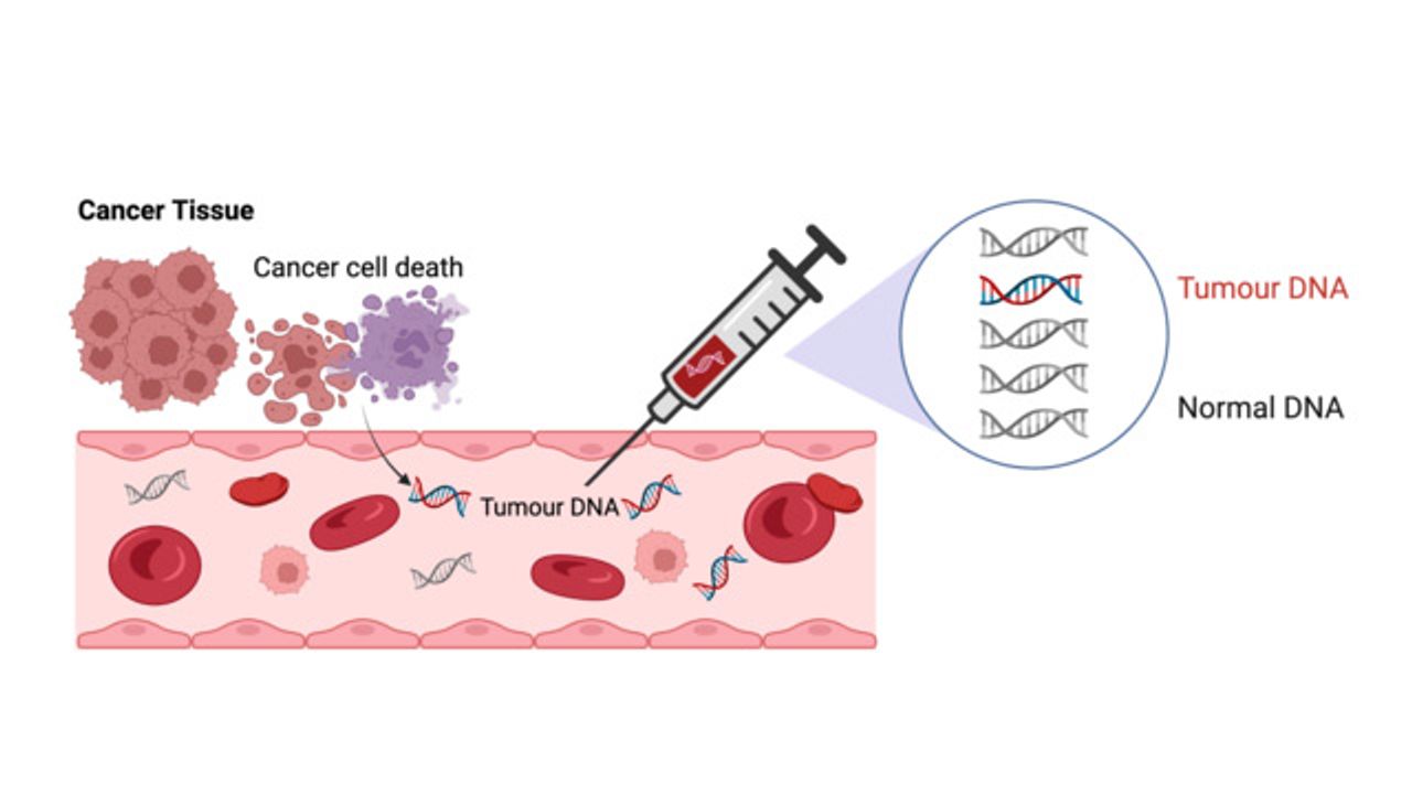 Blood Test Pinpoints Colon Cancer Patients Needing Chemotherapy