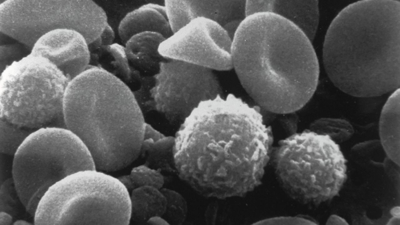 Umbilical Cord Cells Can Be Donated to Siblings With Cerebral Palsy
