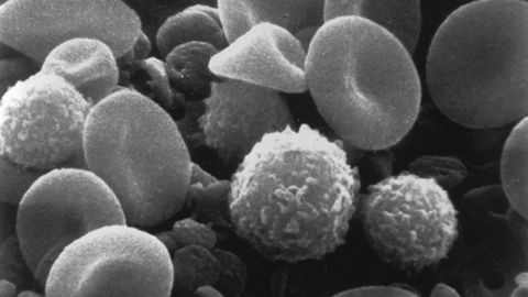 Umbilical Cord Cells Can Be Donated to Siblings With Cerebral Palsy