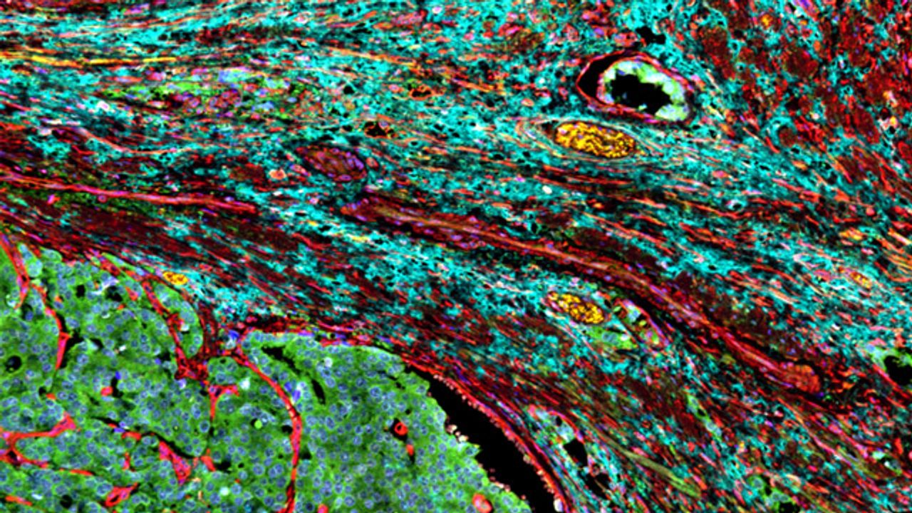 Cancer-Associated Fibroblasts Surrounding a Prostate Tumor