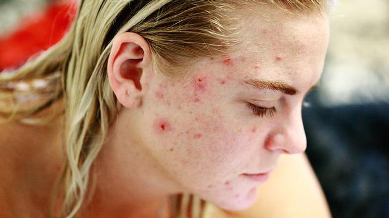 New Approach to Eliminating Acne-Related Bacteria