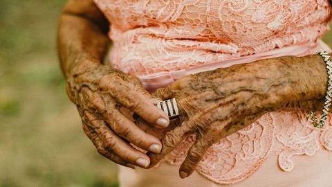 49 Genetic Variants That Increase the Risk of Varicose Veins Identified