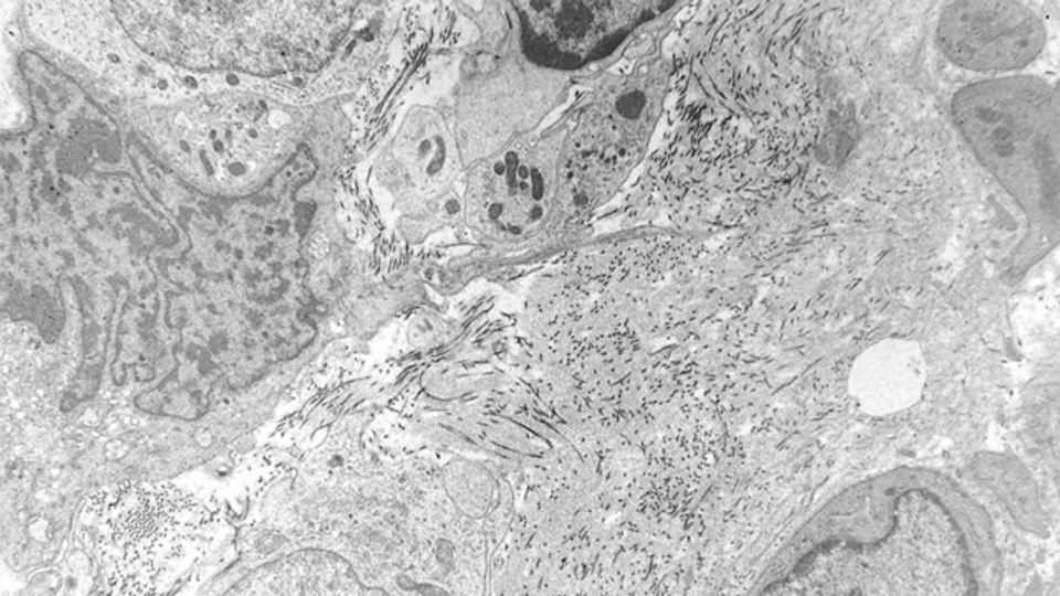 How Tumors Create Cancer-Promoting Immune Cells content piece image