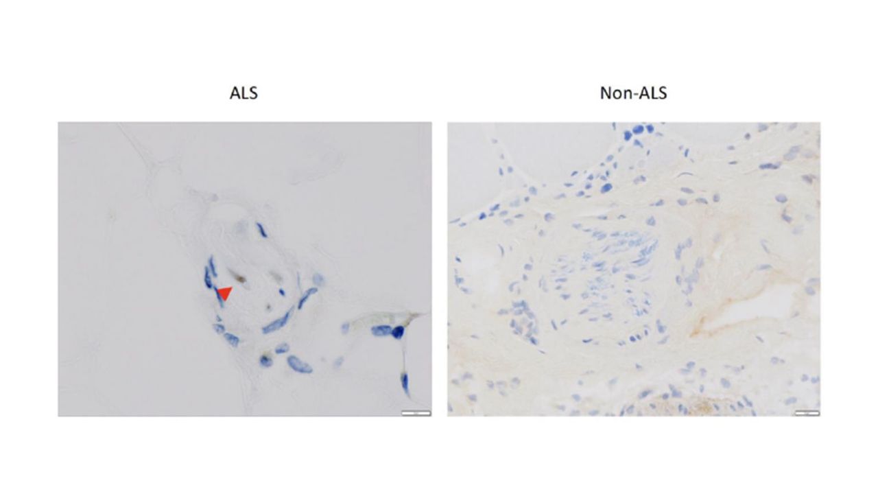 Muscle Biopsy Could Prove Effective as Early ALS Diagnosis
