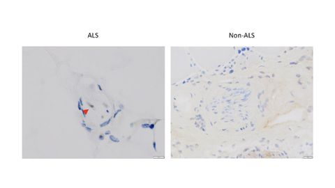 Muscle Biopsy Could Prove Effective as Early ALS Diagnosis