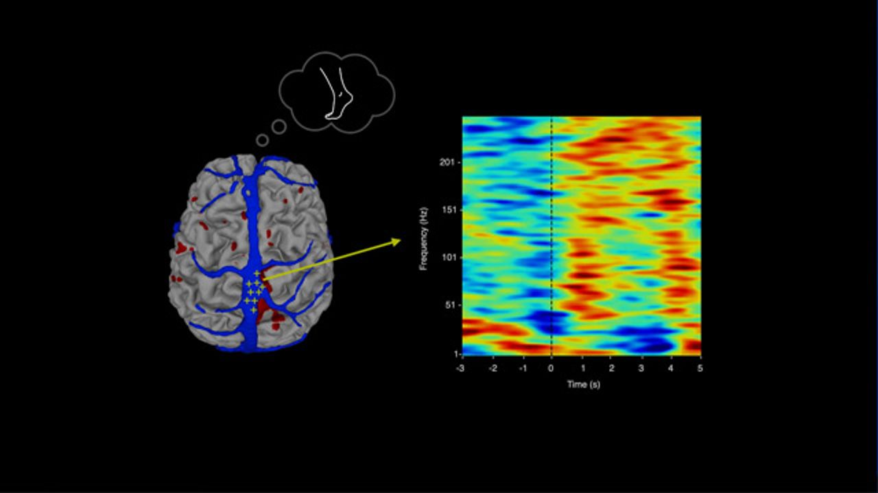 A Brain Implant That Turns Your Thoughts Into Text