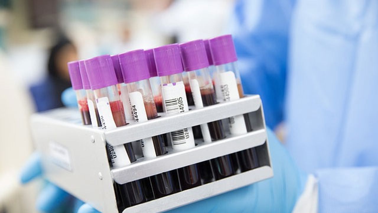 Blood Test Developed To Predict Liver Cancer Risk