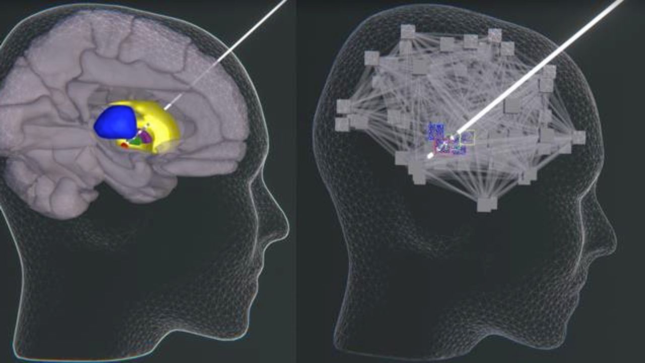 Digital Model Reveals How Electricity Stimulates the Parkinson's Brain