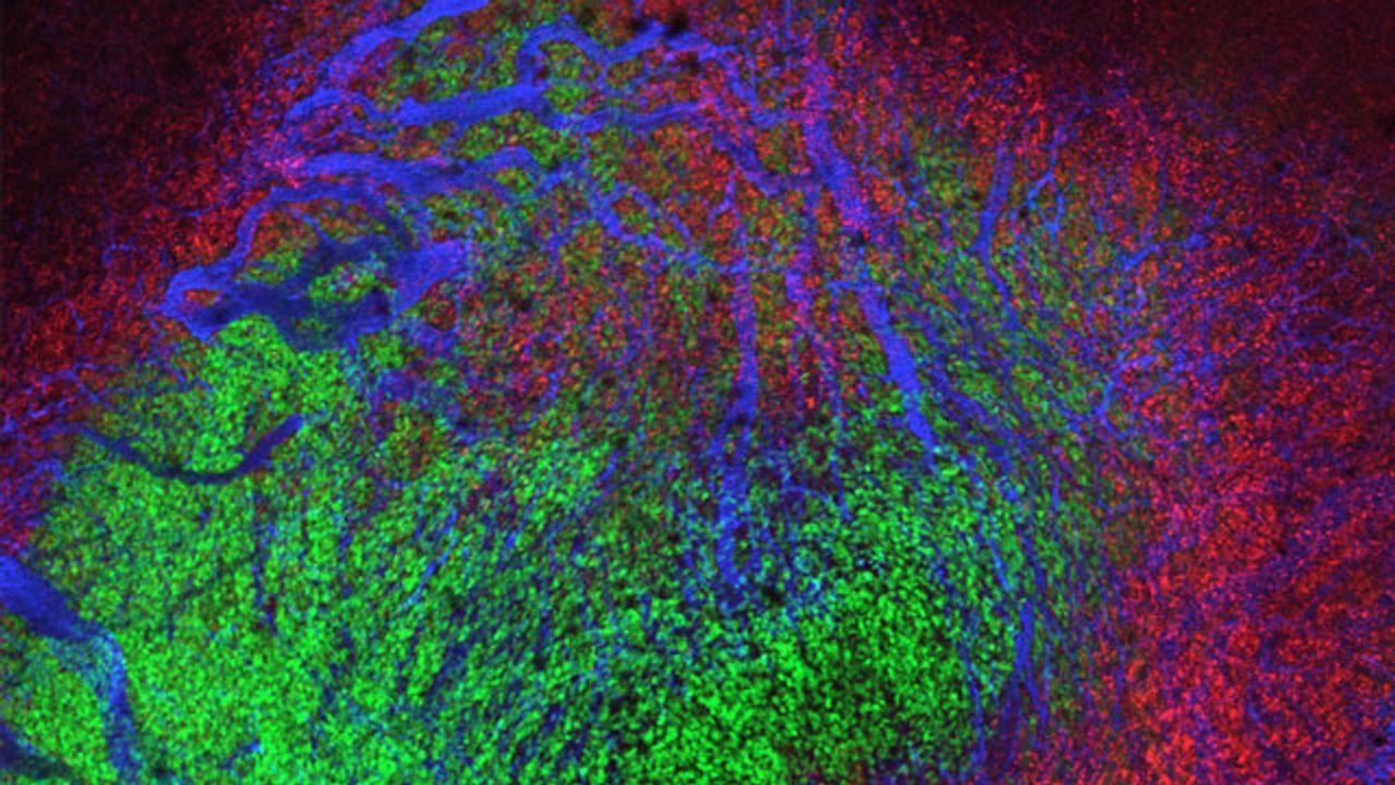 Lipid Nanoparticles Deliver Drugs Past Tumor Defenses