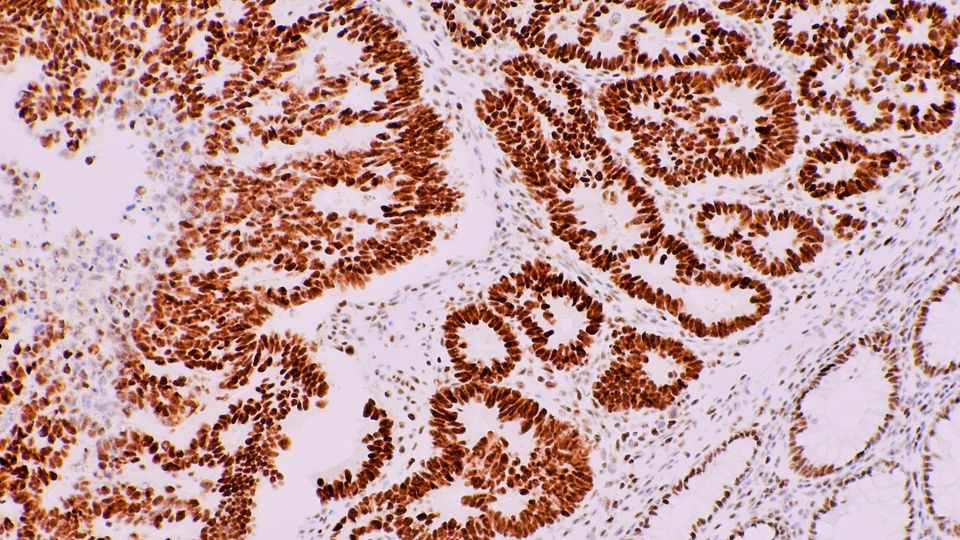 A microscopic image of colon cancer cells.
