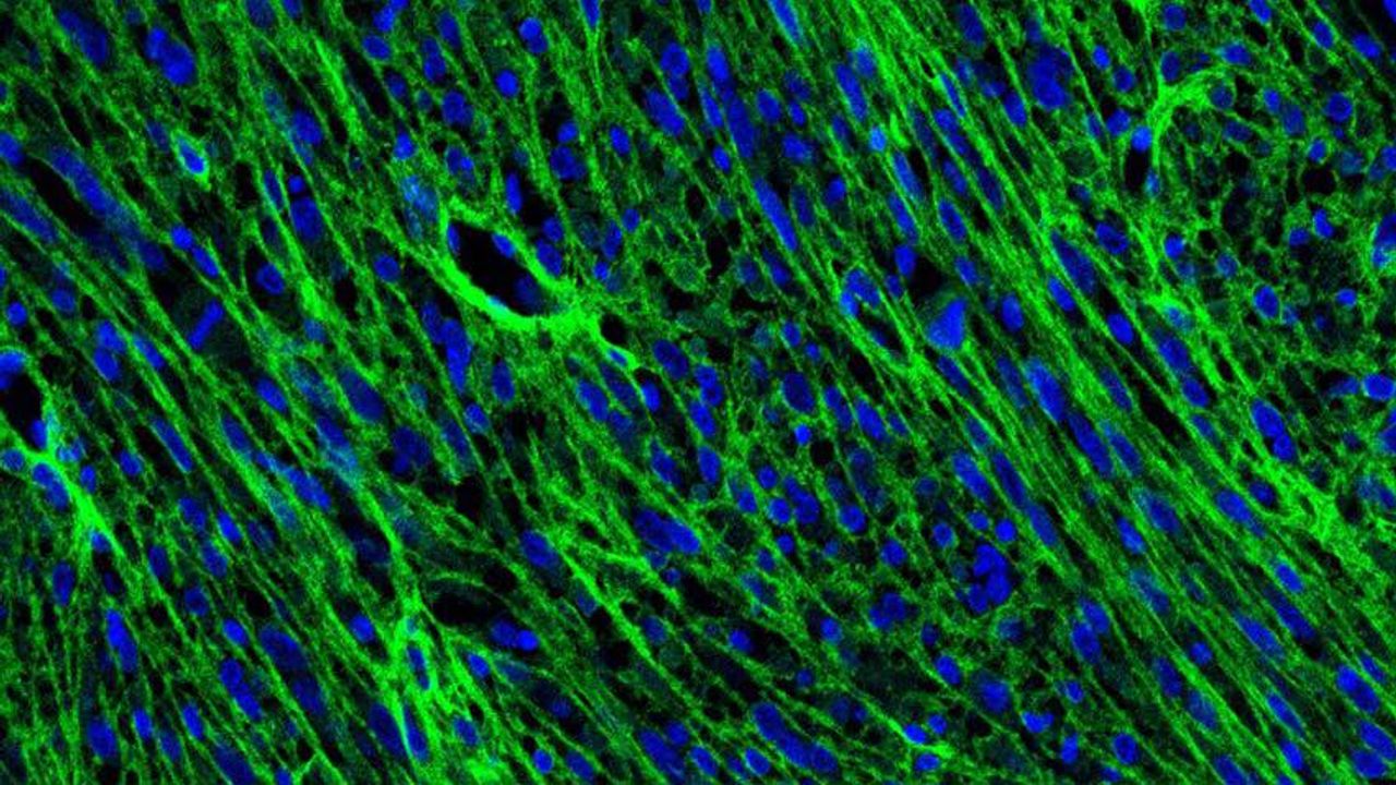 Dynamic Cells May Drive the Spread of Brain Tumors