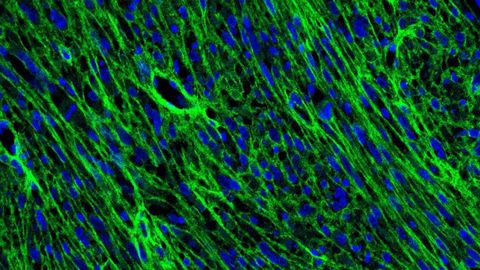 Dynamic Cells May Drive the Spread of Brain Tumors