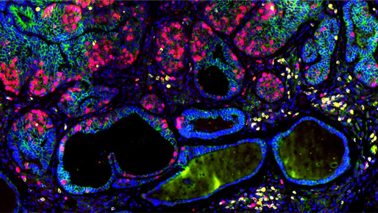 T Cells Inducing Cyst Formation in Breast Cancer