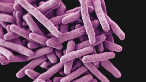Machine Learning Model Predicts Infection With Treatment-Resistant Tuberculosis