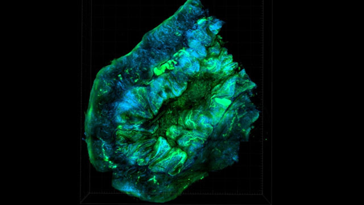 Metabolic Enzyme Key to Ovarian Cancer Spread