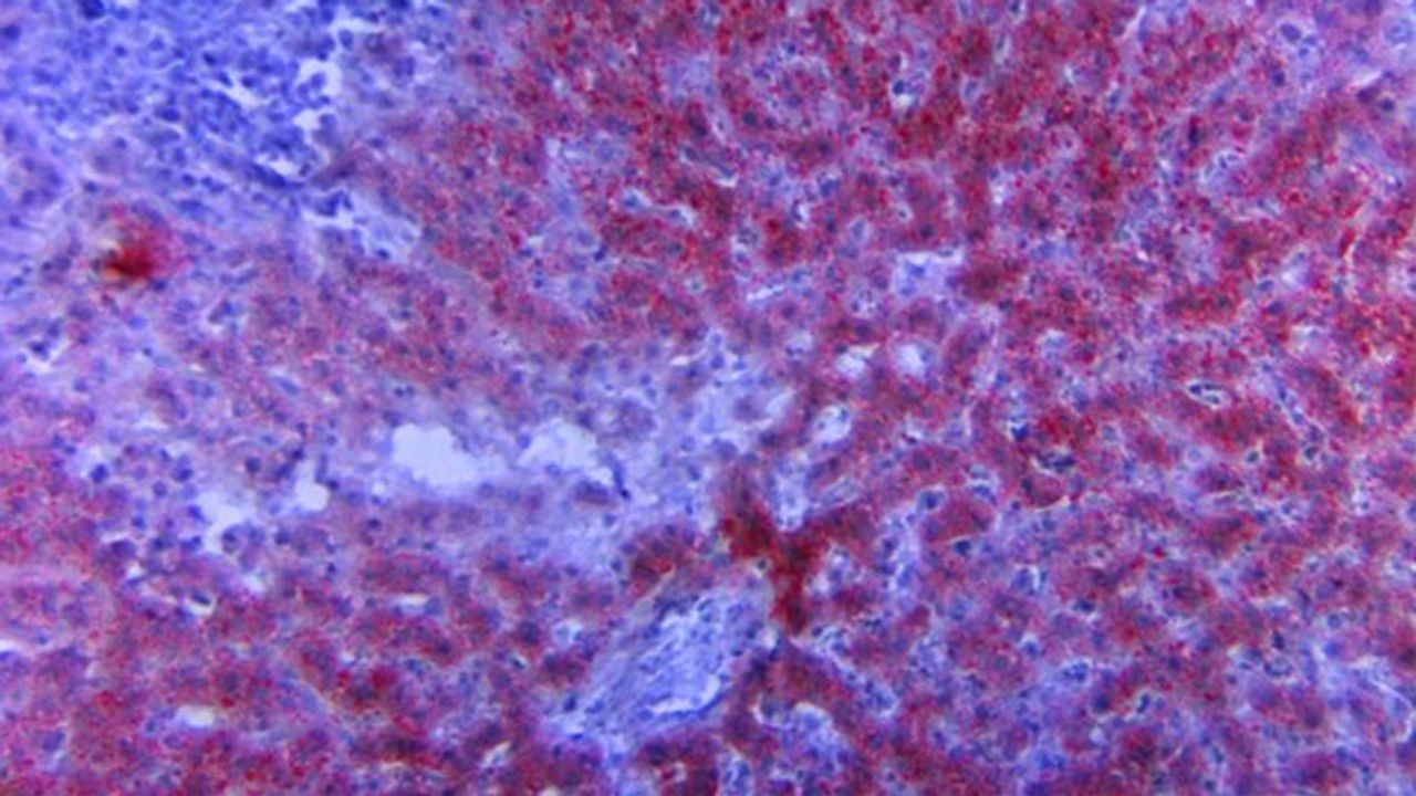 New Testing Procedure Improves Fatty Liver Disease Diagnosis