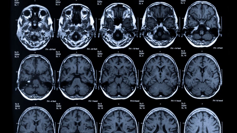 cerebral palsy brain scan comparison