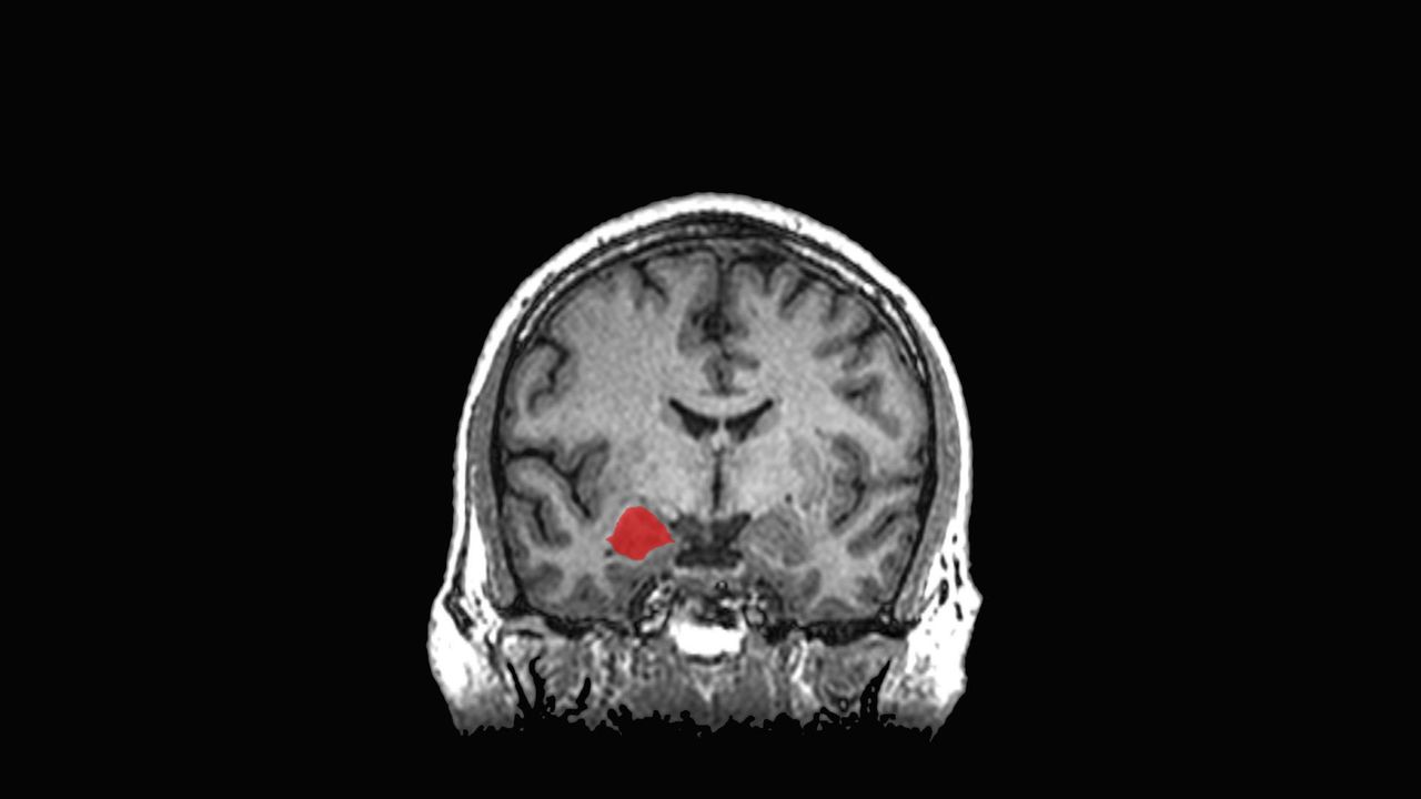 Sex Differences In How Alcohol Affects The Brain Identified