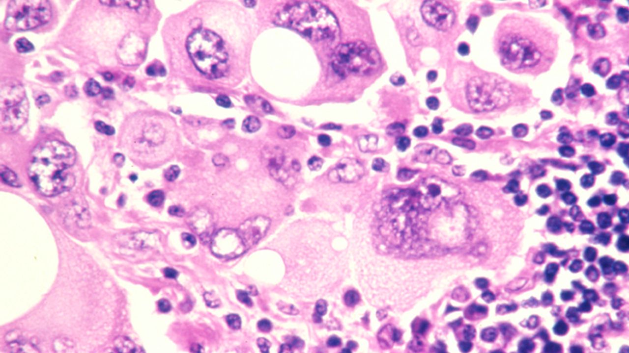 Gene Profiling Technology Reveals Melanoma Biomarkers