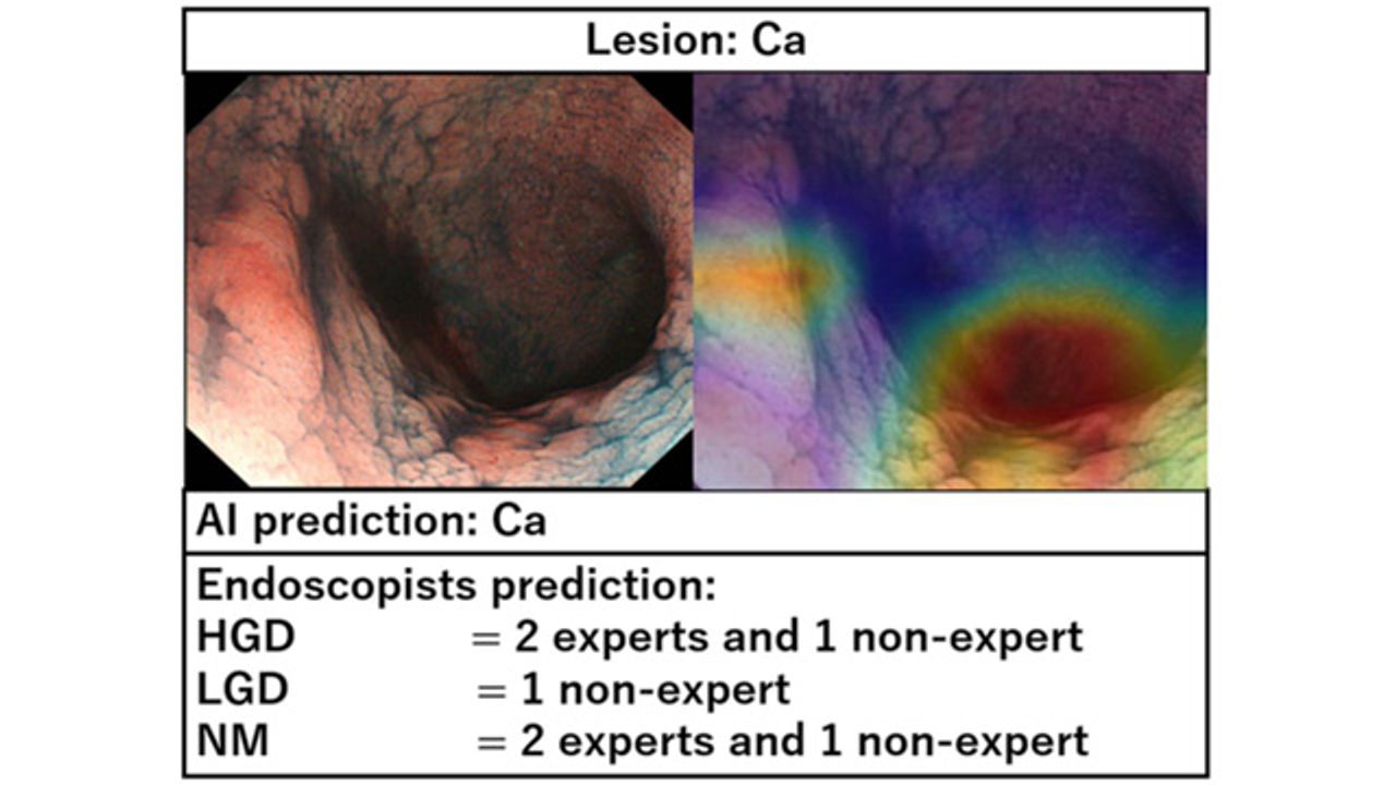 AI Diagnoses Pre-Cancerous Growth Associated With Inflammatory Bowel Disease