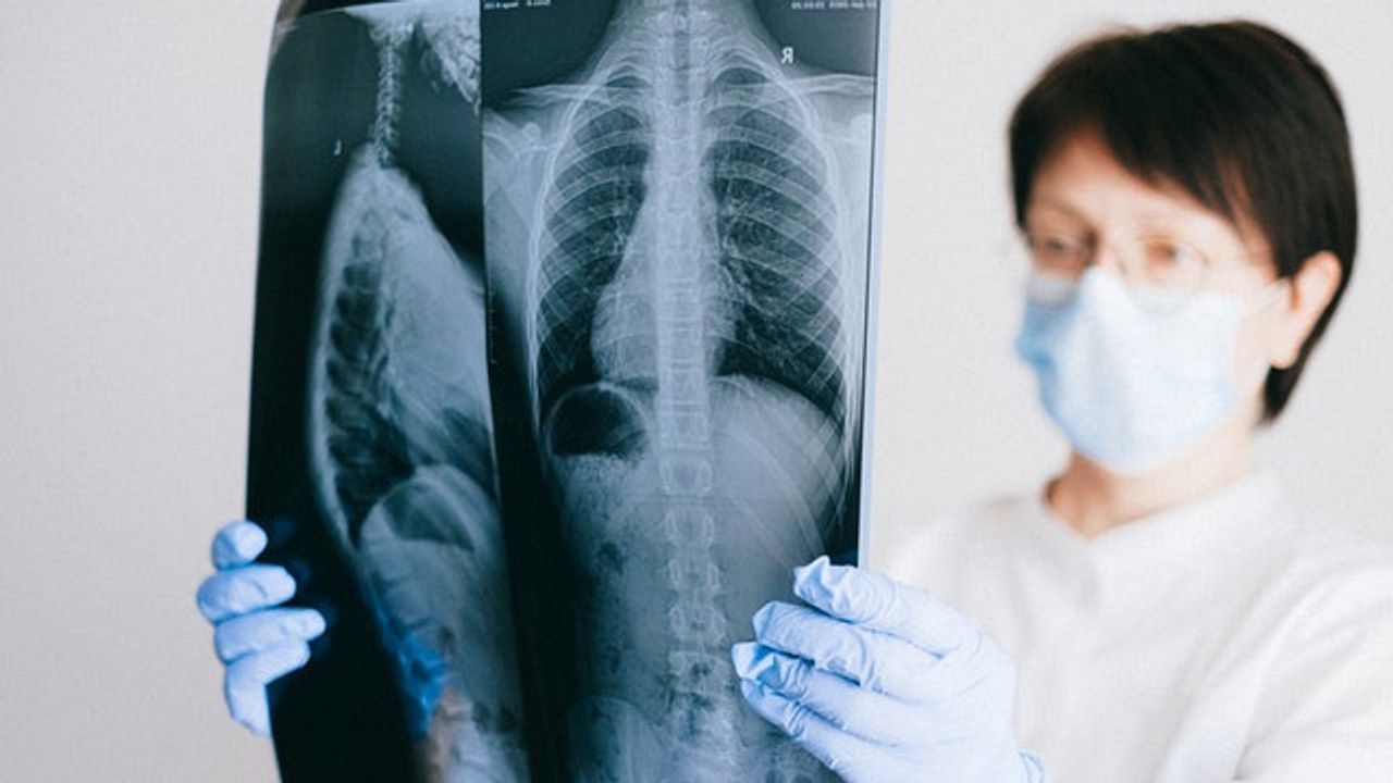 New Therapeutic Approach May Help Reduce Cystic Fibrosis Symptoms
