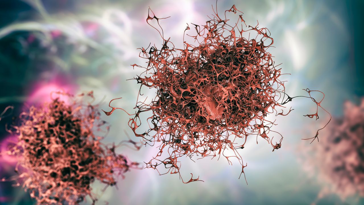AI May Help Diagnose Pancreatic Cancer Earlier From CT Scans