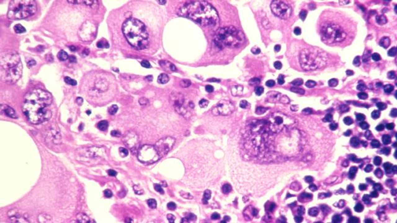 How RNA Molecules Promote Melanoma Metastasis