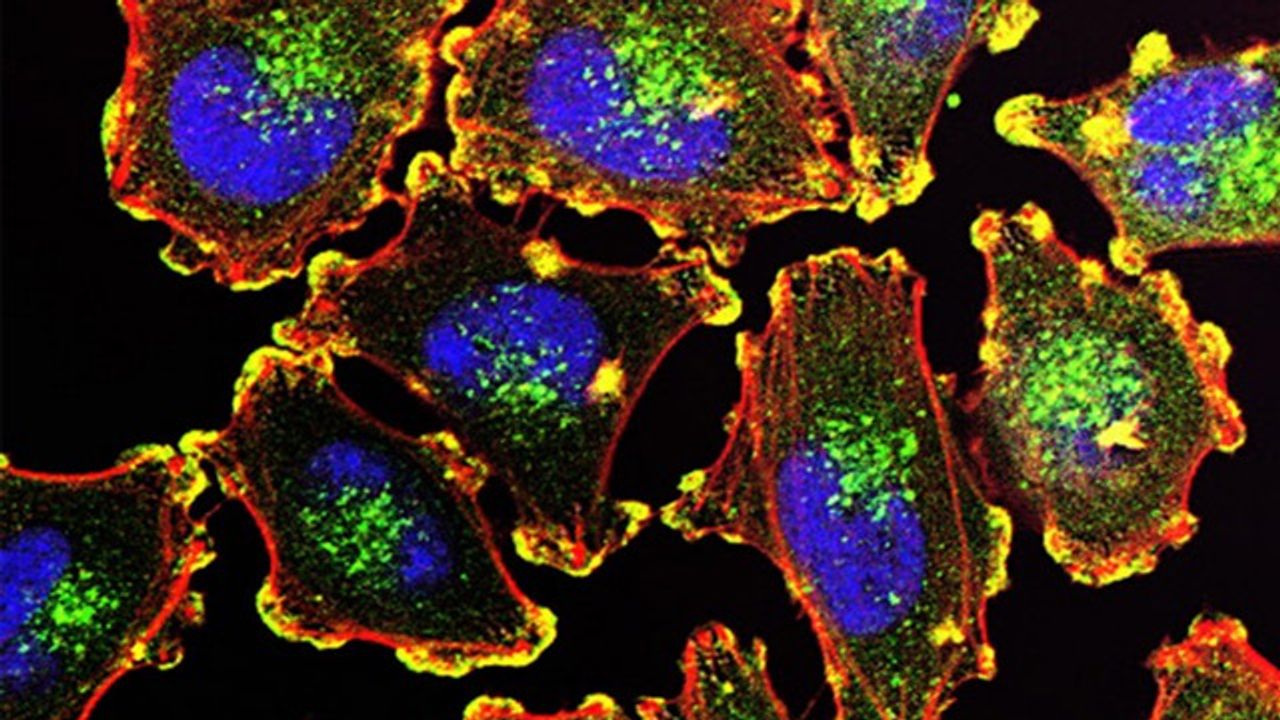 In-Depth Analysis of Melanoma Brain Metastases Reveals New Insights
