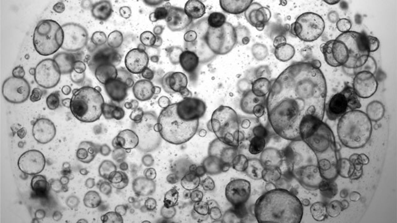 Pancreas Organoids Grown From Patients Predict Chemotherapy Response