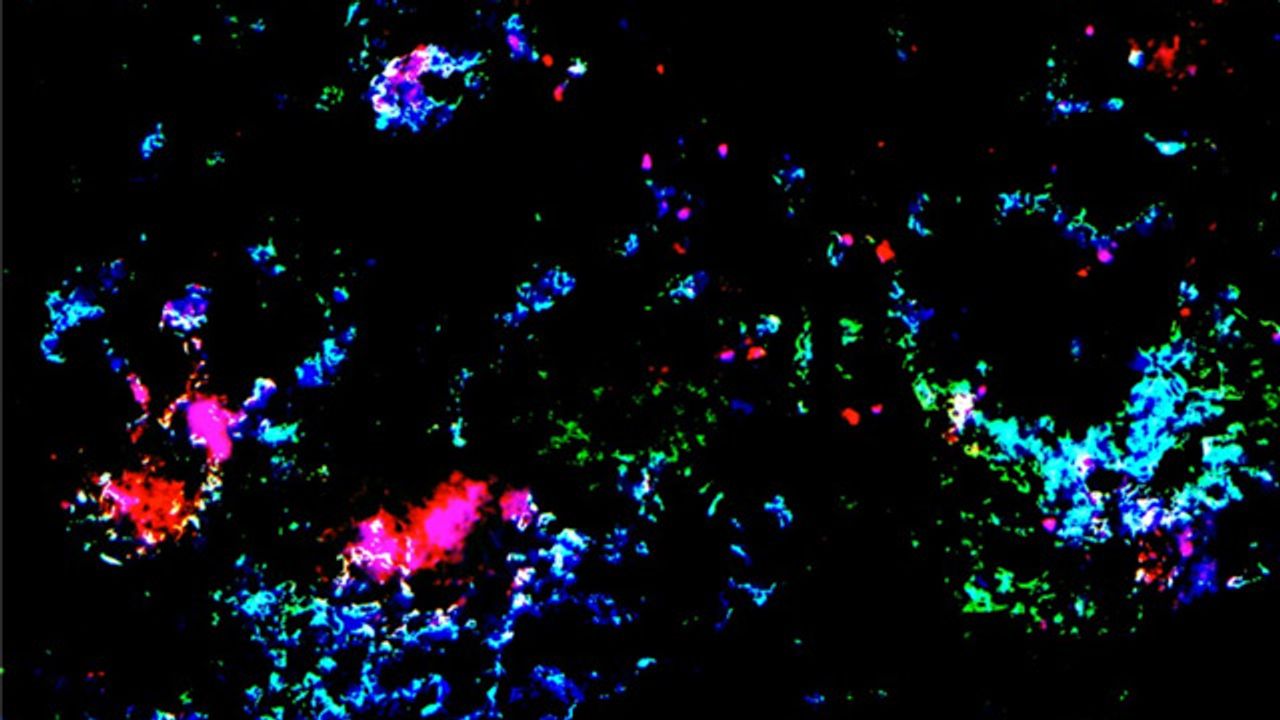 How Different Cancer Types Respond to Nanoparticle Drug Delivery