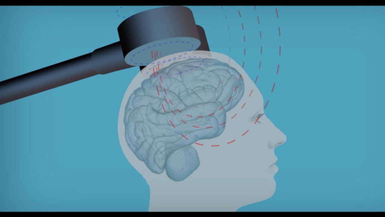 Why Brain Stimulation Shouldn't Be Overlooked as a Treatment for Depression