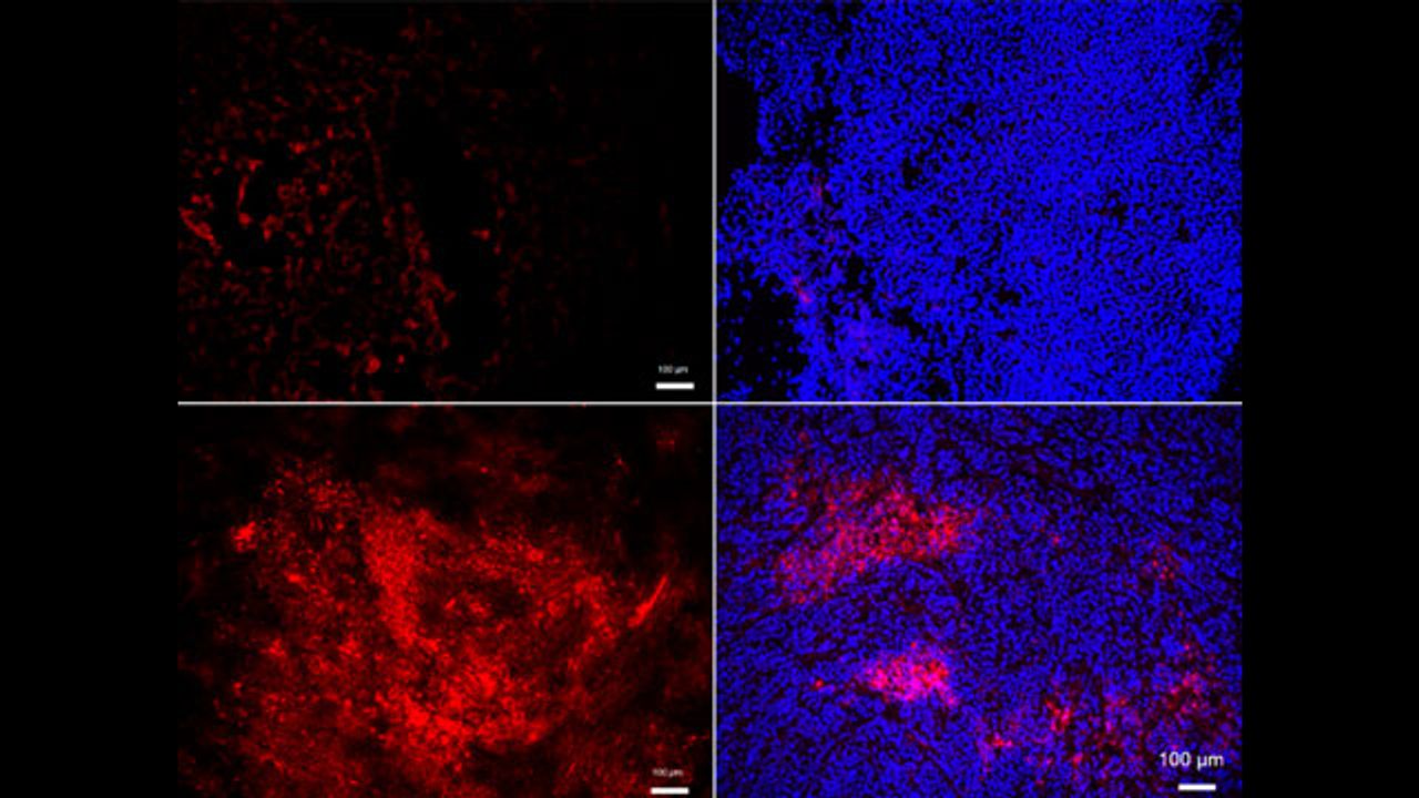 Cancer Metastasis and Atherosclerosis Share a Common Mechanism