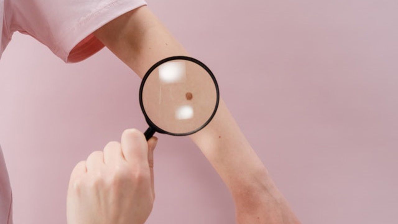Preventing Moles From Turning Into Melanoma