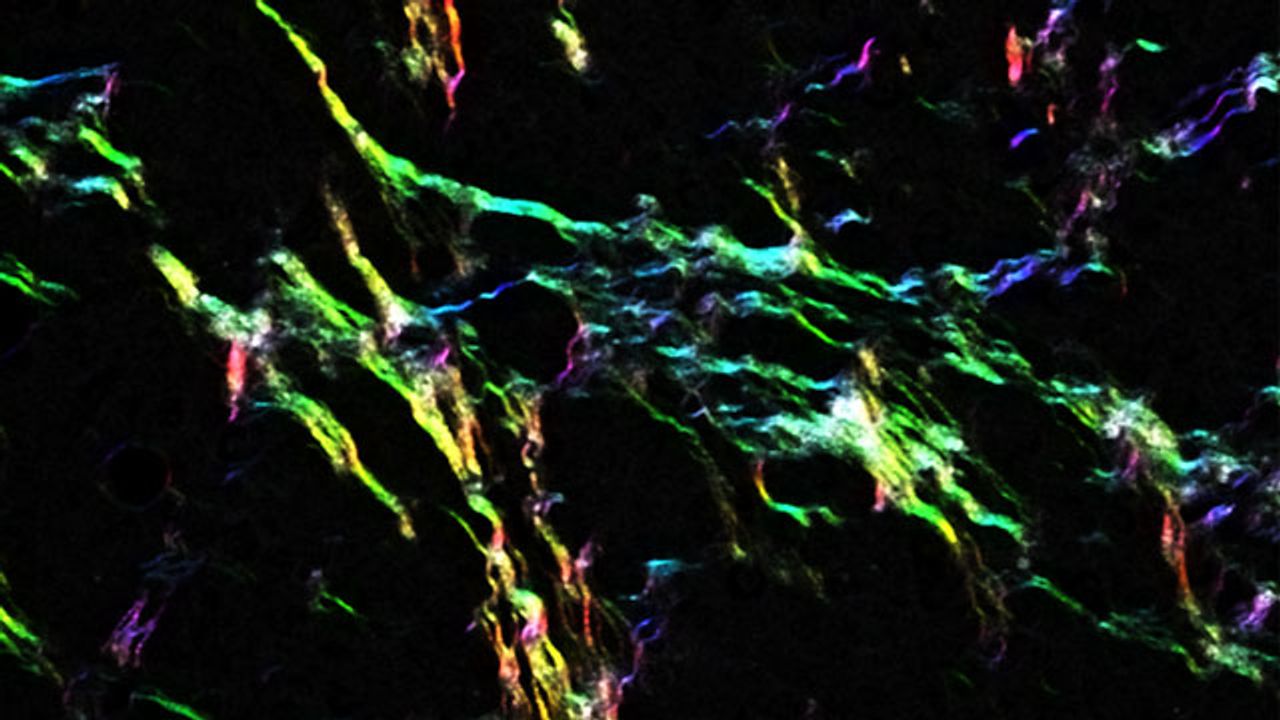 Collagen Is Key to Breast Cancer Spread