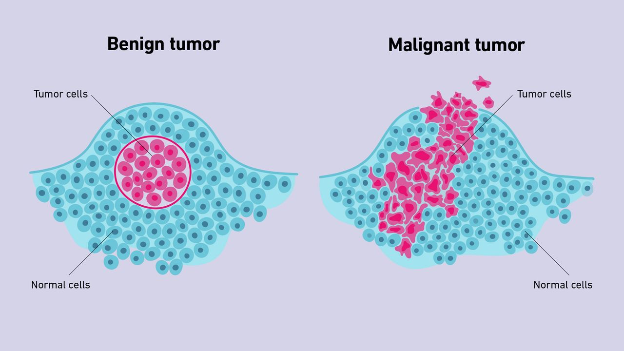 Benign vs Malignant Tumors