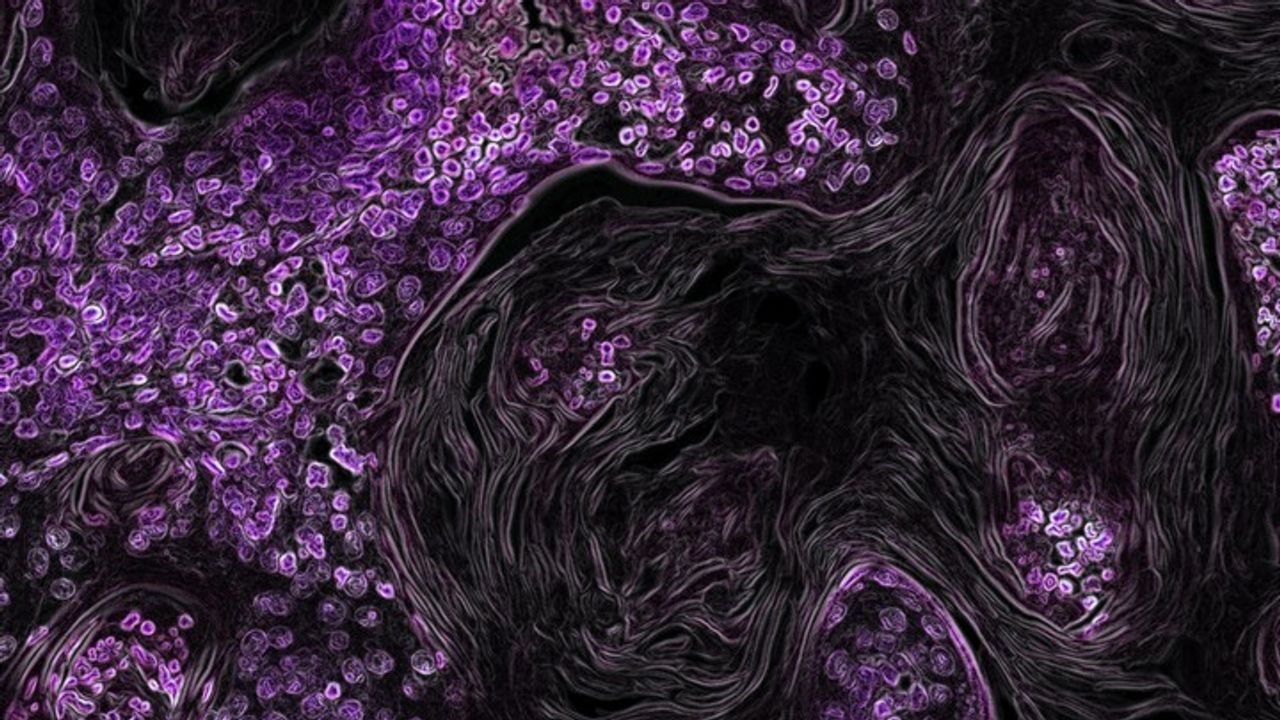 How Fibroblasts in the Tumor Microenvironment Can Influence Drug Sensitivity
