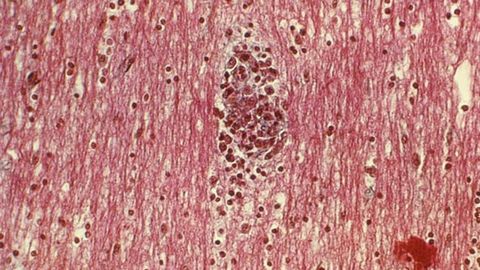 Microglia Colonize the Human Brain in Waves