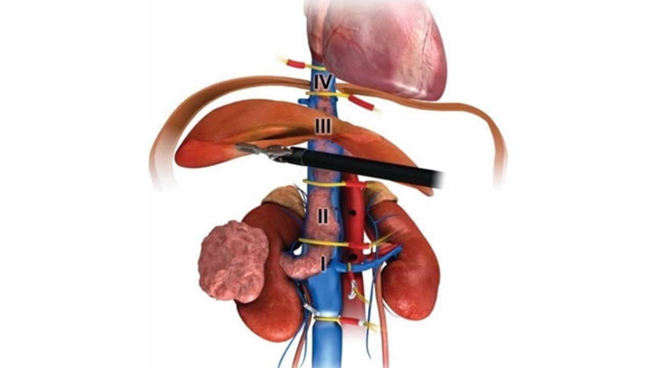 Robotic Kidney Cancer Surgery Is Safe and Effective, Study Finds